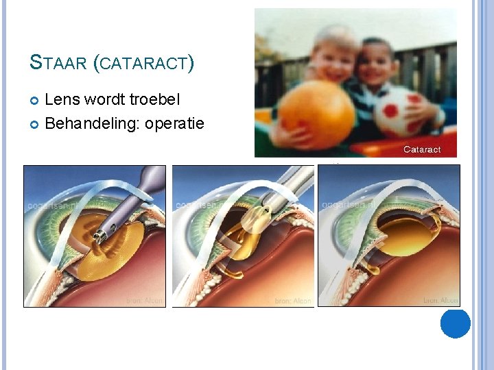 STAAR (CATARACT) Lens wordt troebel Behandeling: operatie 