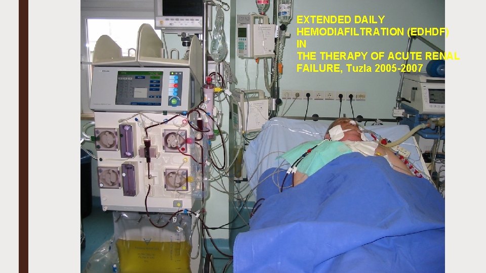 EXTENDED DAILY HEMODIAFILTRATION (EDHDF) IN THERAPY OF ACUTE RENAL FAILURE, Tuzla 2005 -2007 