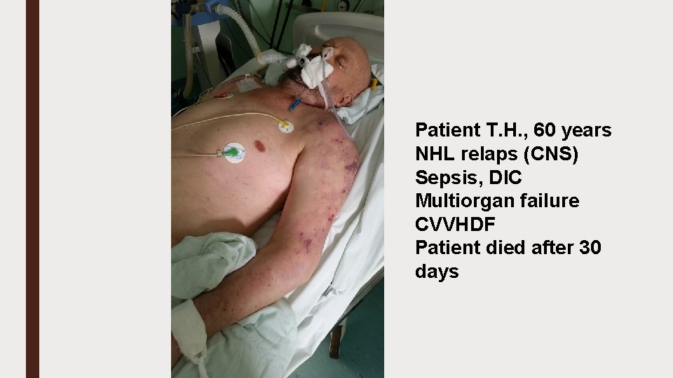 Patient T. H. , 60 years NHL relaps (CNS) Sepsis, DIC Multiorgan failure CVVHDF