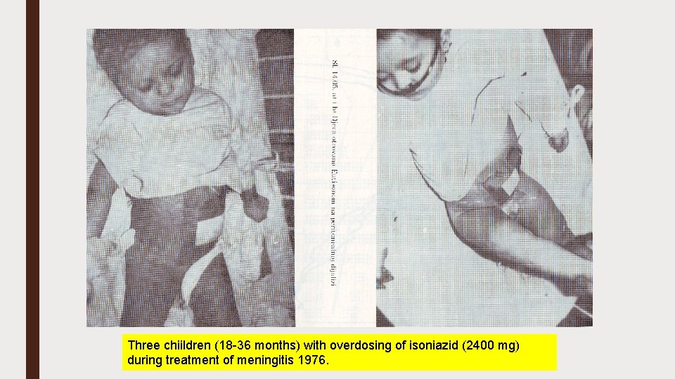 Three chiildren (18 -36 months) with overdosing of isoniazid (2400 mg) during treatment of