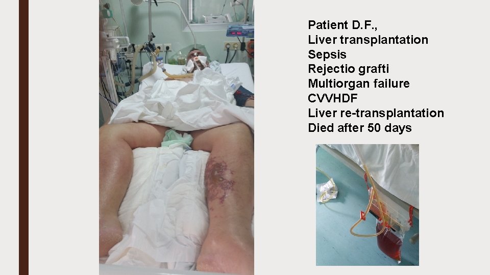 Patient D. F. , Liver transplantation Sepsis Rejectio grafti Multiorgan failure CVVHDF Liver re-transplantation