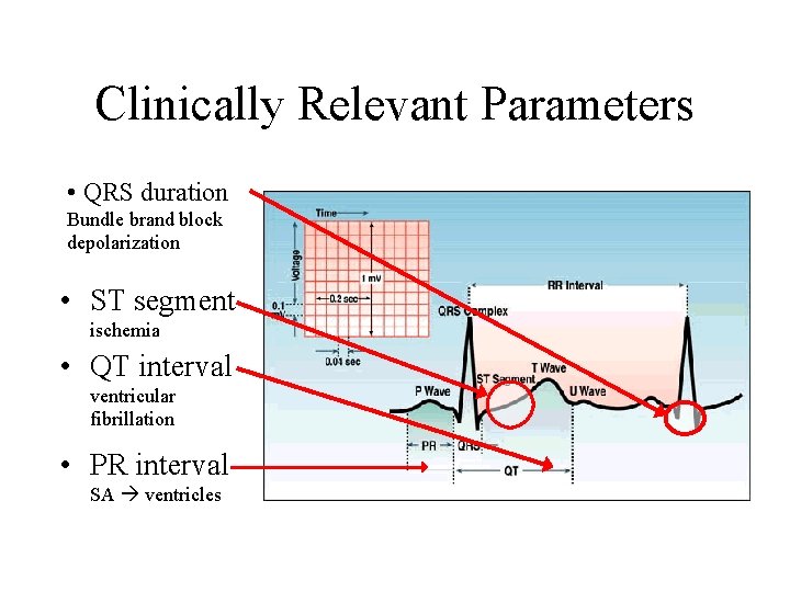 Clinically Relevant Parameters • QRS duration Bundle brand block depolarization • ST segment ischemia