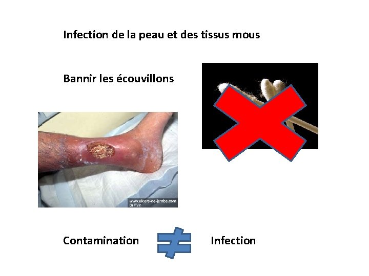 Infection de la peau et des tissus mous Bannir les écouvillons Contamination Infection 
