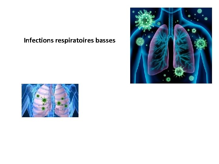 Infections respiratoires basses 