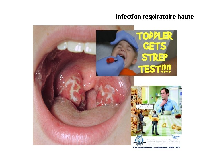 Infection respiratoire haute 