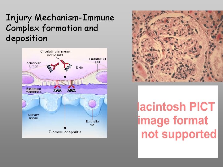Injury Mechanism-Immune Complex formation and deposition 