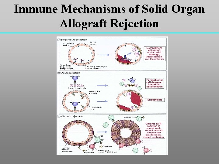 Immune Mechanisms of Solid Organ Allograft Rejection 