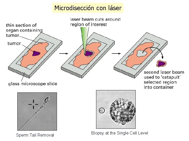 Microdisección con láser Sperm Tail Removal Biopsy at the Single Cell Level 