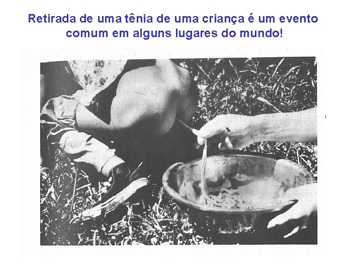Retirada de uma tênia de uma criança é um evento comum em alguns lugares