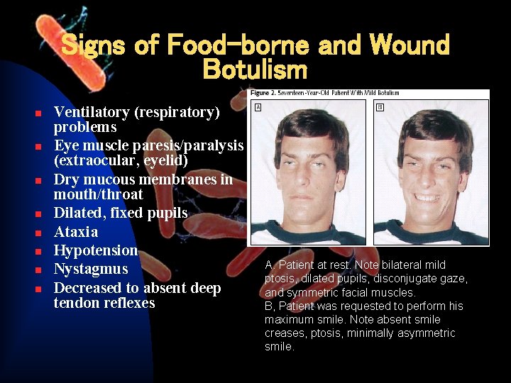 Signs of Food-borne and Wound Botulism n n n n Ventilatory (respiratory) problems Eye