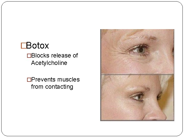 �Botox �Blocks release of Acetylcholine �Prevents muscles from contacting 