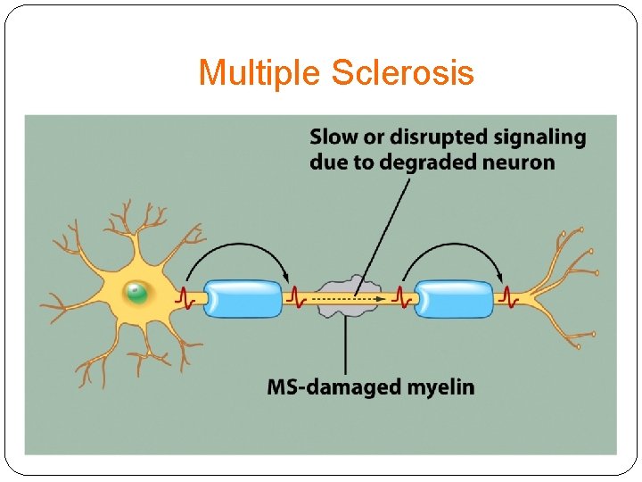 Multiple Sclerosis 