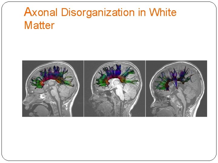 Axonal Disorganization in White Matter 