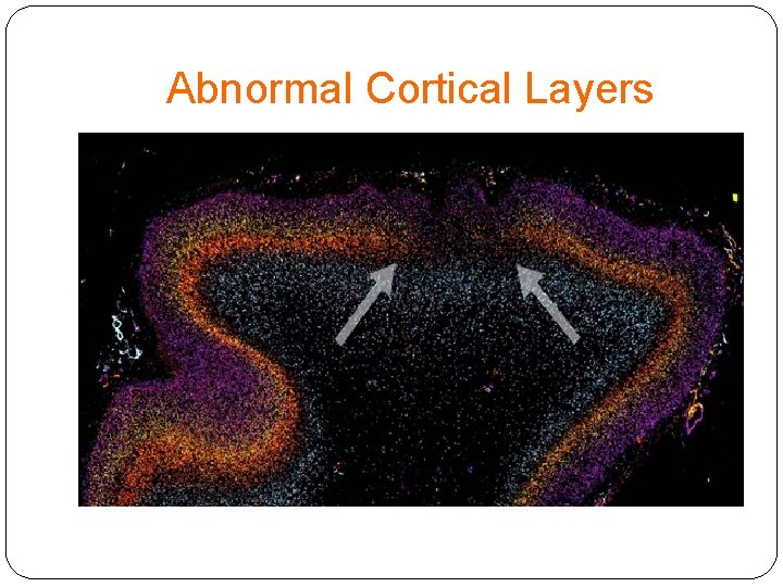 Abnormal Cortical Layers 