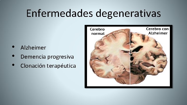 Enfermedades degenerativas • • • Alzheimer Demencia progresiva Clonación terapéutica 