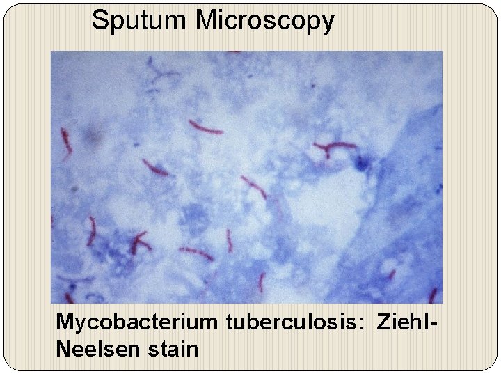 Sputum Microscopy Mycobacterium tuberculosis: Ziehl. Neelsen stain 