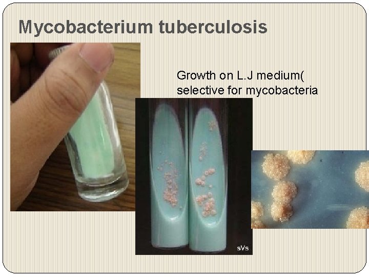 Mycobacterium tuberculosis Growth on L. J medium( selective for mycobacteria 