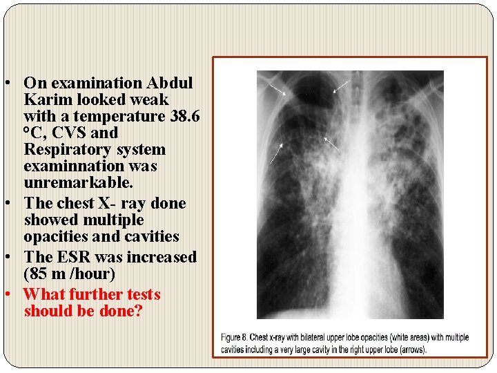  • On examination Abdul Karim looked weak with a temperature 38. 6 °C,