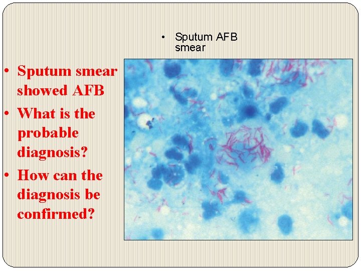  • Sputum AFB smear • Sputum smear showed AFB • What is the