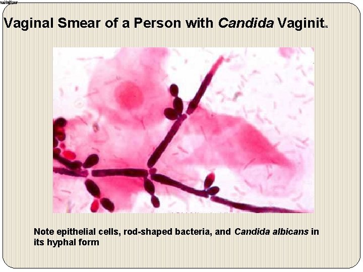 Vaginal Smear of a Person with Candida Vaginit Note epithelial cells, rod-shaped bacteria, and