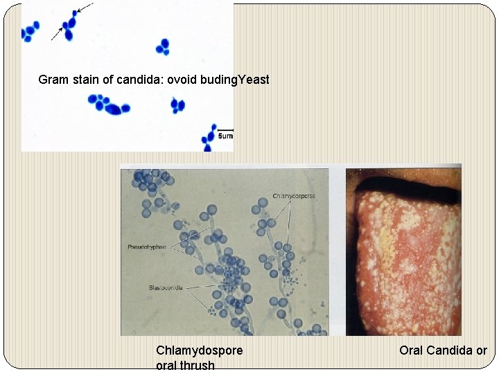 Gram stain of candida: ovoid buding. Yeast Chlamydospore oral thrush Oral Candida or 