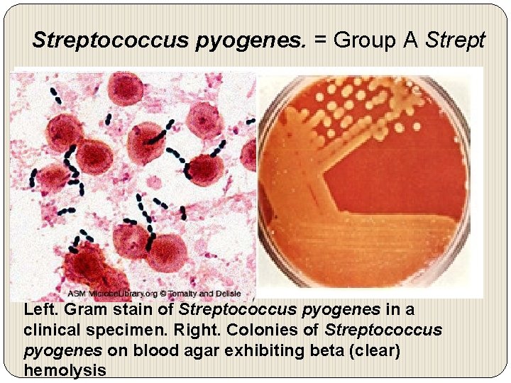 Streptococcus pyogenes. = Group A Strept Left. Gram stain of Streptococcus pyogenes in a