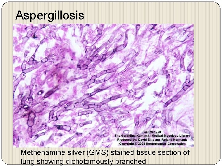 Aspergillosis Methenamine silver (GMS) stained tissue section of lung showing dichotomously branched 