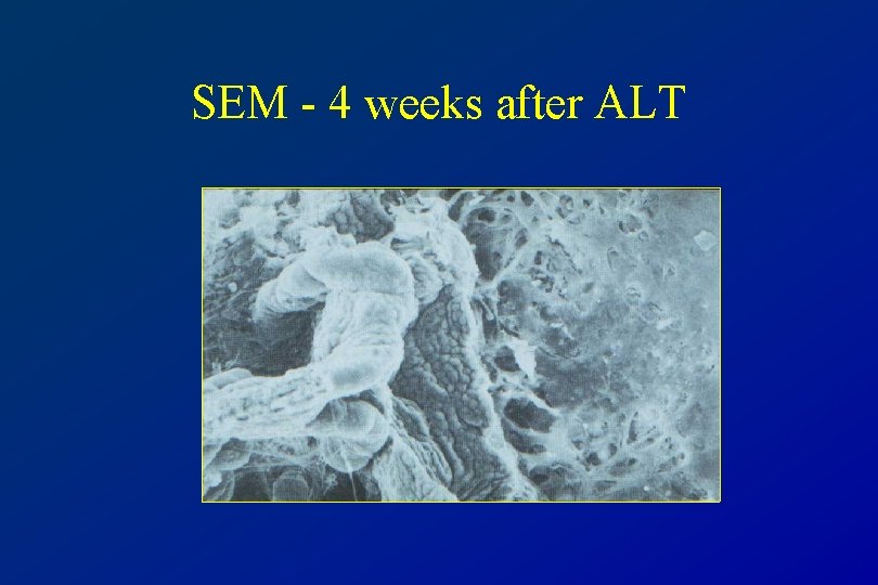 SEM - 4 weeks after ALT 