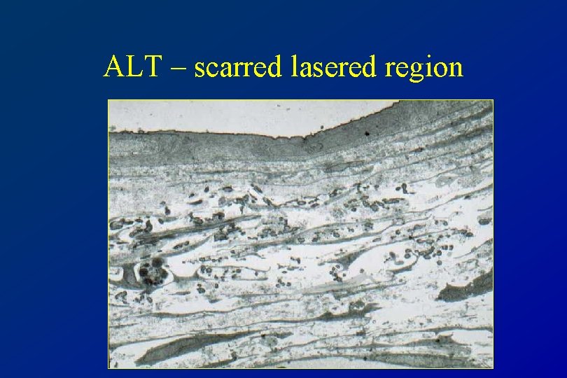 ALT – scarred lasered region 