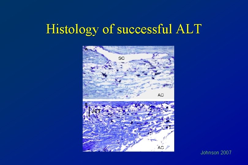Histology of successful ALT Johnson 2007 