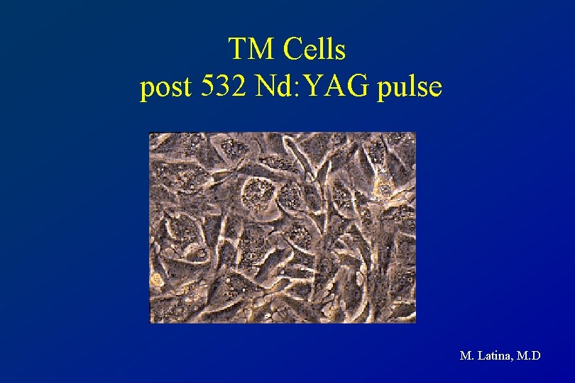 TM Cells post 532 Nd: YAG pulse M. Latina, M. D 