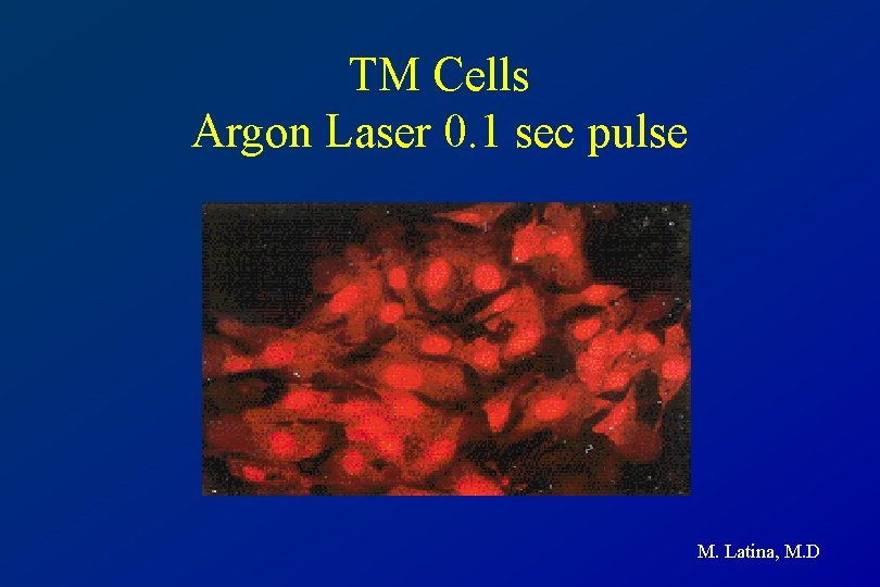 TM Cells Argon Laser 0. 1 sec pulse M. Latina, M. D 