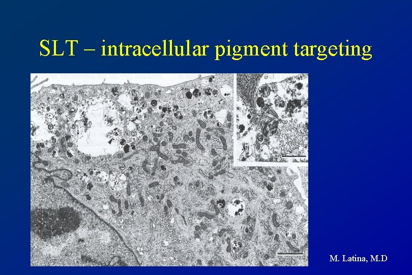 SLT – intracellular pigment targeting M. Latina, M. D 