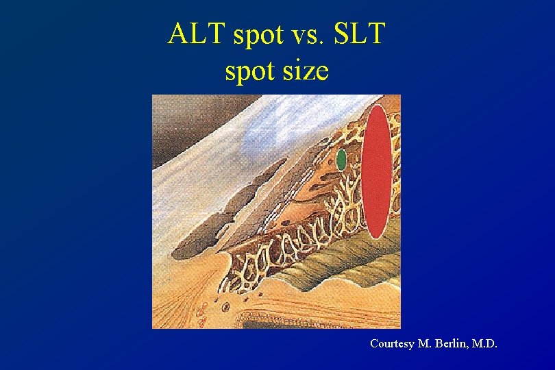 ALT spot vs. SLT spot size Courtesy M. Berlin, M. D. 