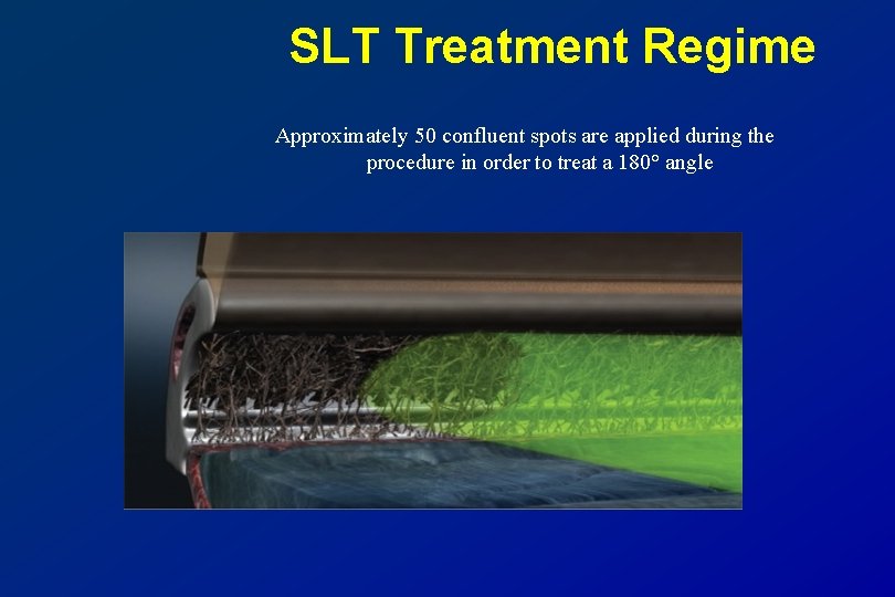 SLT Treatment Regime Approximately 50 confluent spots are applied during the procedure in order