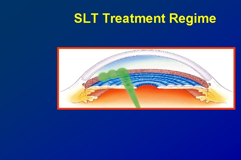 SLT Treatment Regime 