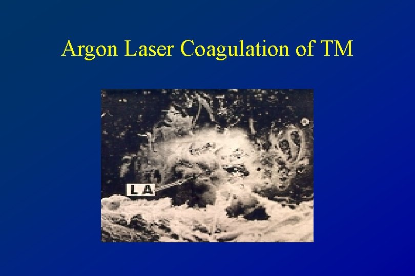 Argon Laser Coagulation of TM 