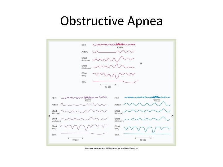 Obstructive Apnea 