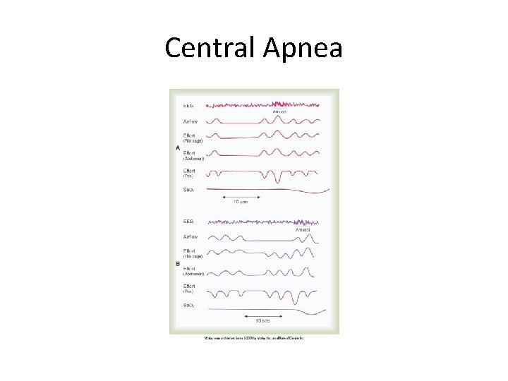 Central Apnea 