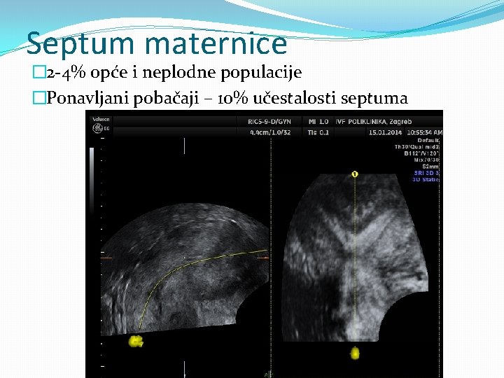 Septum maternice � 2 -4% opće i neplodne populacije �Ponavljani pobačaji – 10% učestalosti