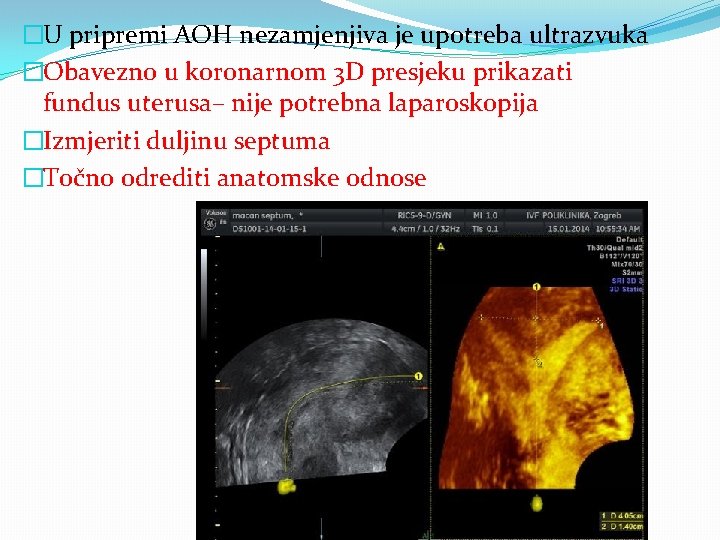 �U pripremi AOH nezamjenjiva je upotreba ultrazvuka �Obavezno u koronarnom 3 D presjeku prikazati