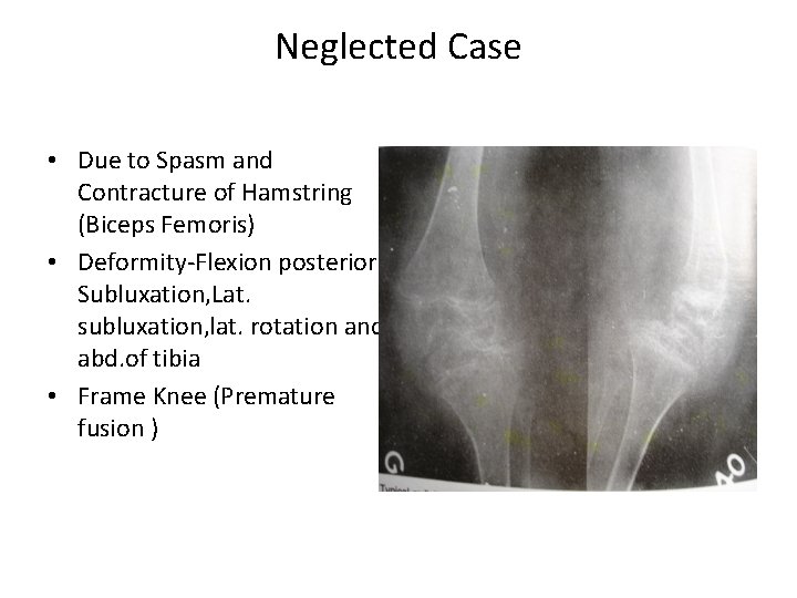 Neglected Case • Due to Spasm and Contracture of Hamstring (Biceps Femoris) • Deformity-Flexion