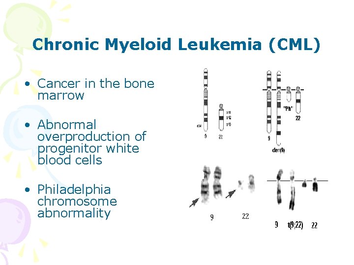 Chronic Myeloid Leukemia (CML) • Cancer in the bone marrow • Abnormal overproduction of