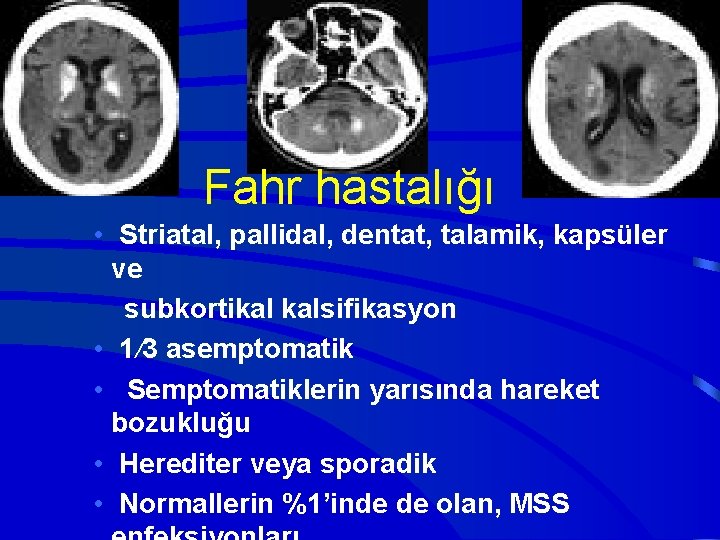 Fahr hastalığı • Striatal, pallidal, dentat, talamik, kapsüler ve subkortikal kalsifikasyon • 1/3 asemptomatik