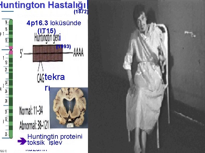 Huntington Hastalığı (1872) 4 p 16. 3 loküsünde (IT 15) i (1993) tekra rı