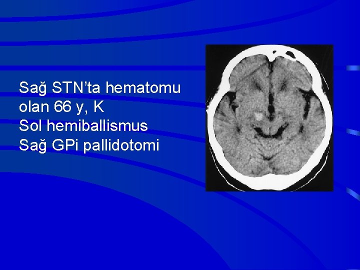 Sağ STN’ta hematomu olan 66 y, K Sol hemiballismus Sağ GPi pallidotomi 