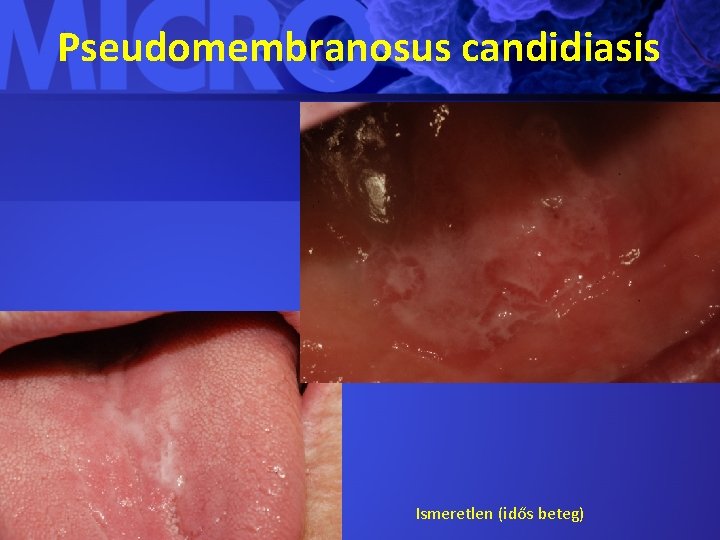 Pseudomembranosus candidiasis Ismeretlen (idős beteg) 