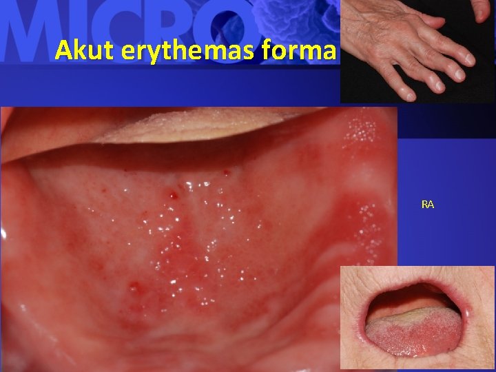 Akut erythemas forma RA 