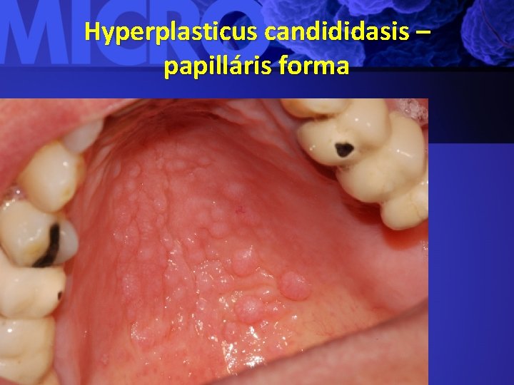 Hyperplasticus candididasis – papilláris forma 