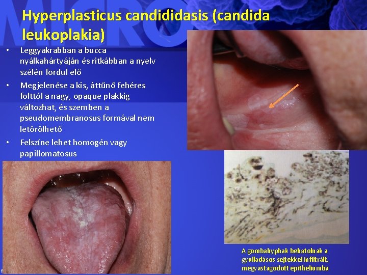  • • • Hyperplasticus candididasis (candida leukoplakia) Leggyakrabban a bucca nyálkahártyáján és ritkábban